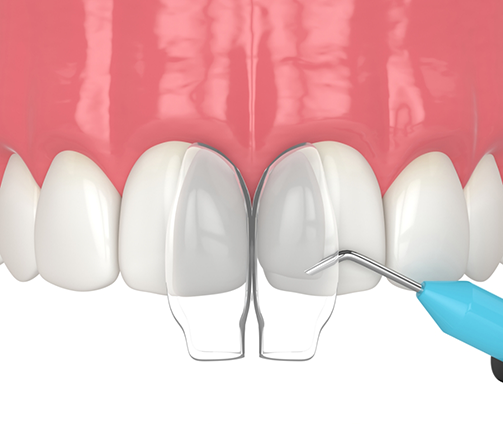 Illustration of dental bonding material being applied to a chipped tooth
