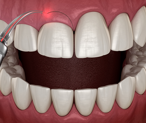 Illustration of a dental laser treating an uneven gumline