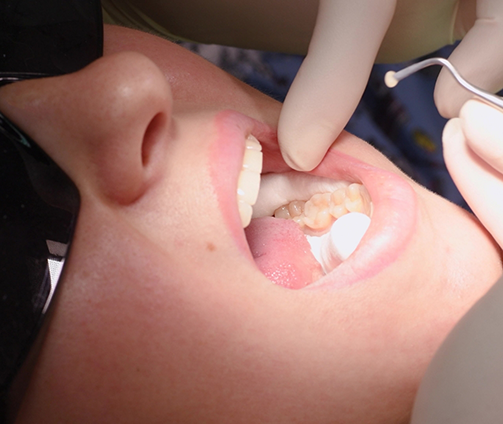 Close up of a dentist placing a white filling in a patient's tooth