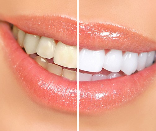 Before and after image of stained and whiter teeth